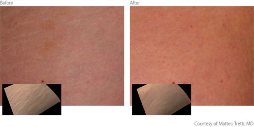 BeforeAfter2 Non-Ablative Courtesy of Matteo Tretti Clementoni M.D. Before And After Non-Ablative Treatment