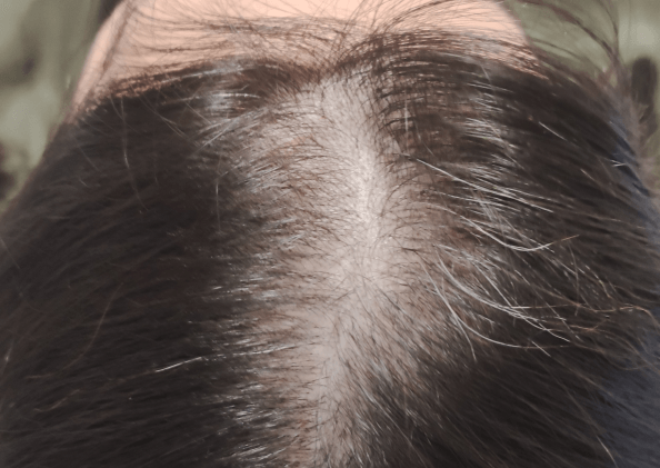 FoLix hair loss treatment before and after photos