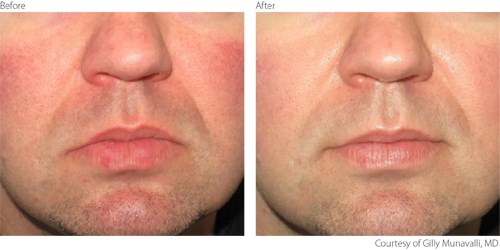 BeaforeAfter2 Rosacea Courtesy of Gilly Munavalli M.D.