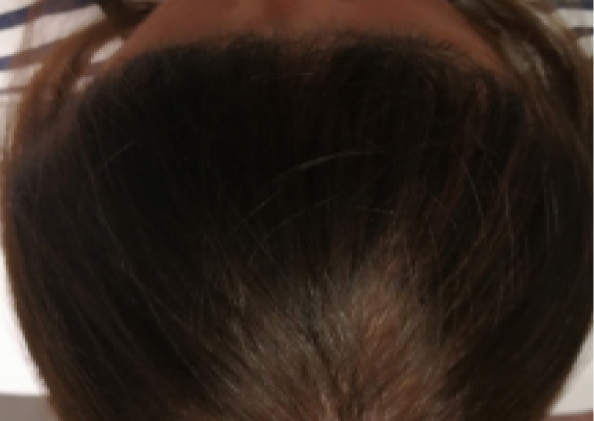 FoLix hair loss treatment before and after photos