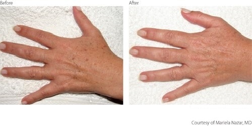 Before After Pigmentation Hands Before After Pigmentation Hands