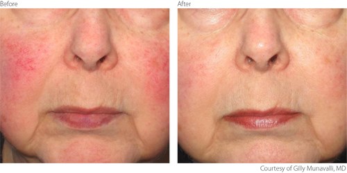 BeaforeAfter1 Rosacea Courtesy of Gilly Munavalli M.D.