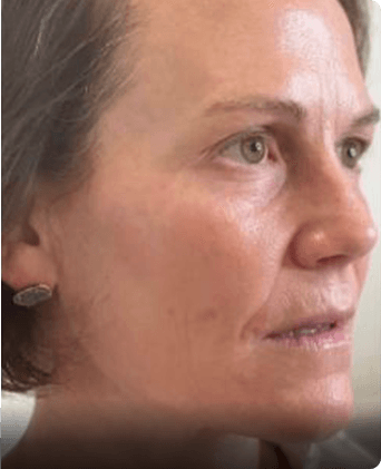 smoothglo treatment before and after