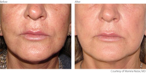 Before And After Photorejuvenation Before And After Photorejuvenation