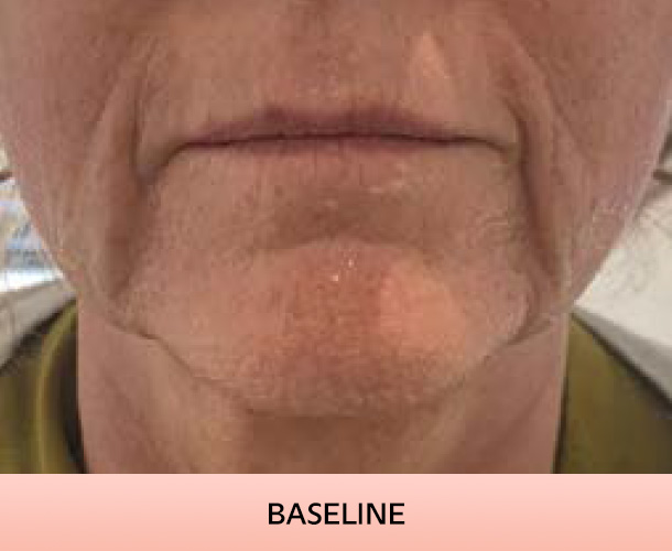 nasalfolds_baseline-4