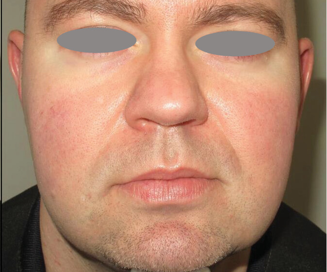 Before and After Rosacea treatment