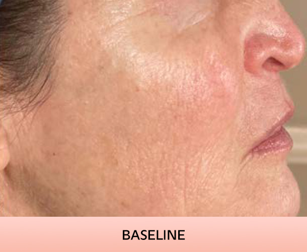 cheekbone_baseline-4 Cheekbones before triLift treatment