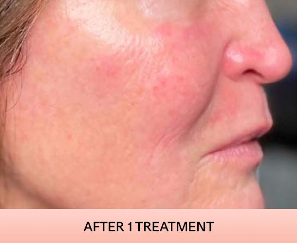 cheekbone_after-4 Cheekbones after triLift treatment