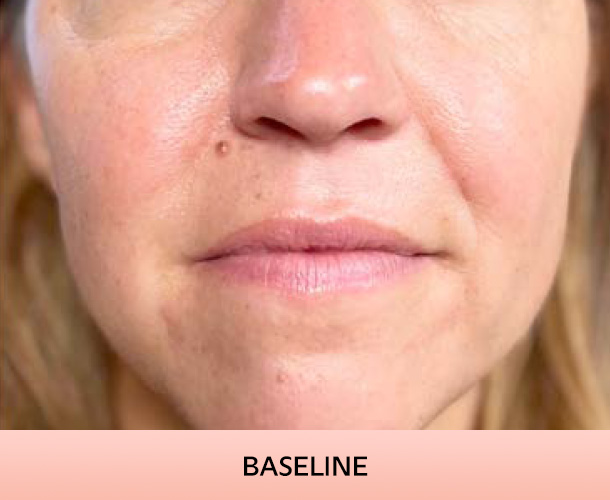nasalfolds_baseline-3