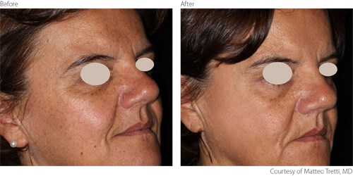 BeforeAfter1-Non-Ablative-Courtesy-of-Matteo-Tretti-Clementoni-M.D. Before And After Non-Ablative procedure